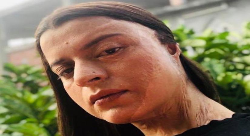 Acid attack survivor Rangoli: Parents would see my face and faint.