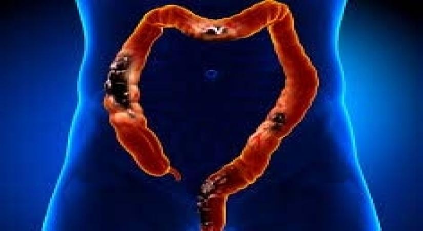 Colorectal Cancer