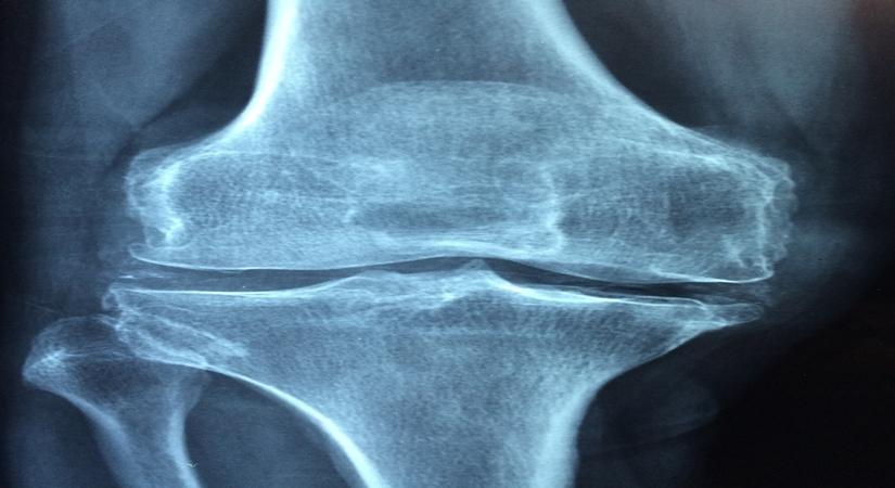 Can running protect bone health?