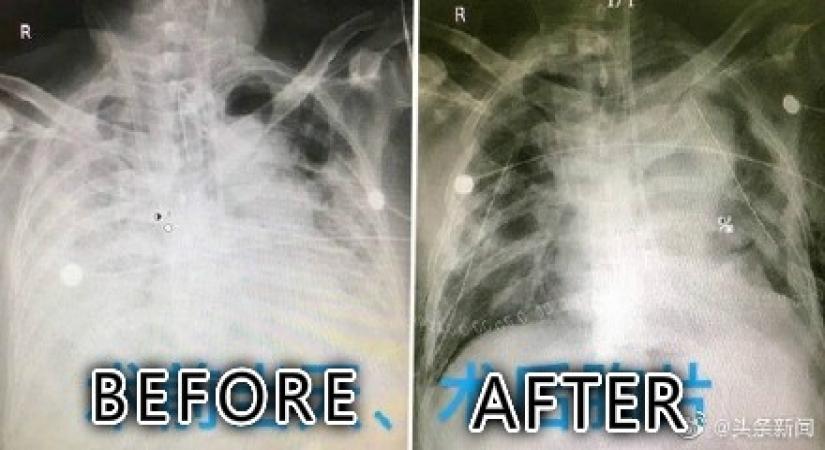 New Delhi, April 5 (IANS) Since all the focus is on finding and treating people who are corona-positive, what about those who have recovered from the deadly COVID-19 disease and are trying to get their life back to normal? Are they going to face reduced lung capacity for the rest of their lives?