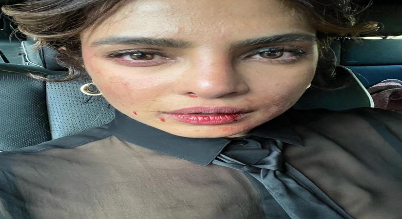 Priyanka Chopra shares picture of 'bruised' face from 'Citadel' set.(photo:Instagram)