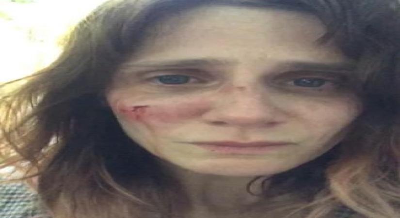 Victim of domestic abuse, French actress posts shocking pics on Instagram