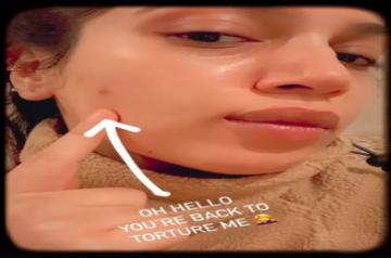 Actress Bhumi Pednekar took to social media on Thursday, to lay bare her pimple woes for fans.